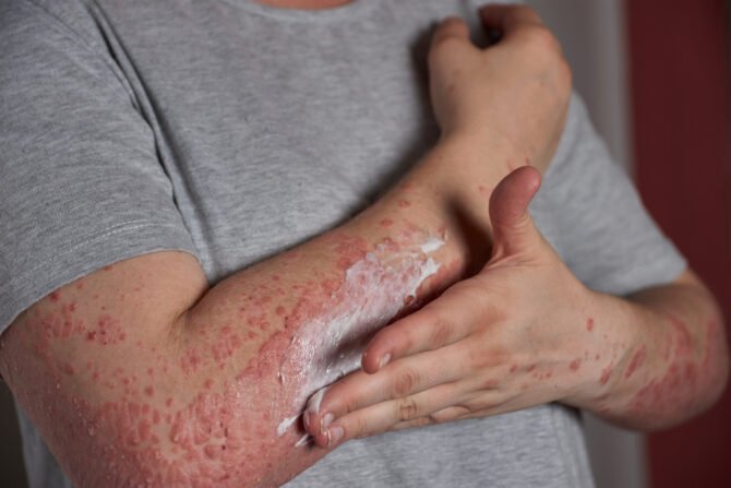 Difference Between Eczema and Psoriasis