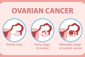 ovarian cancer