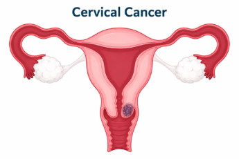 Cervical Cancer.