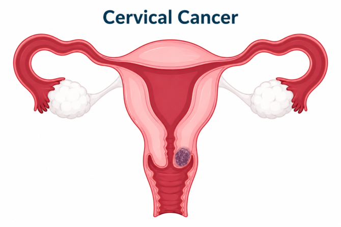 Cervical Cancer.