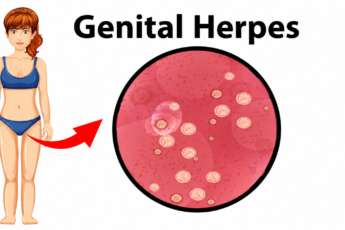 symptoms to genital herpes