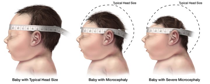 What Is Zika Virus?