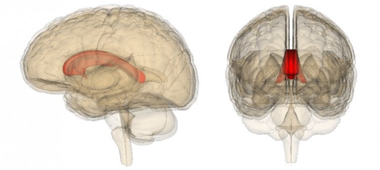 What Is Agenesis Of Corpus Callosum?