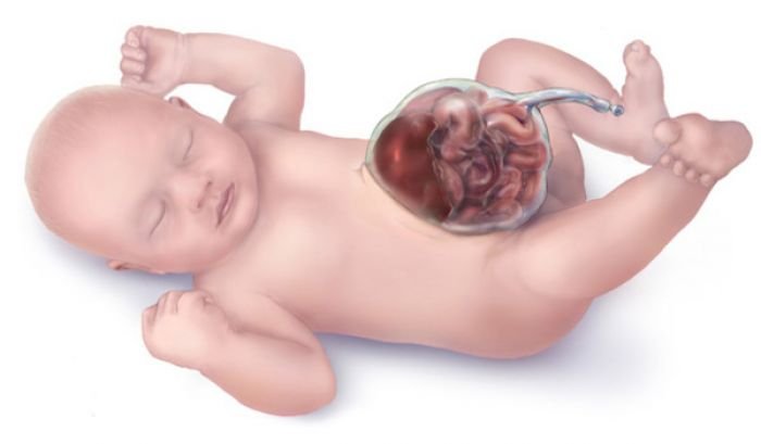 What Is Abdominal Wall Defect? What Is Abdominal Wall Defect?