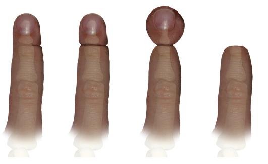 What Is Amniotic Band Syndrome? Healthinfi