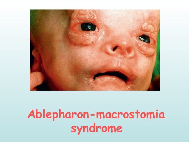 What Is Ablepharon-Macrostomia Syndrome?