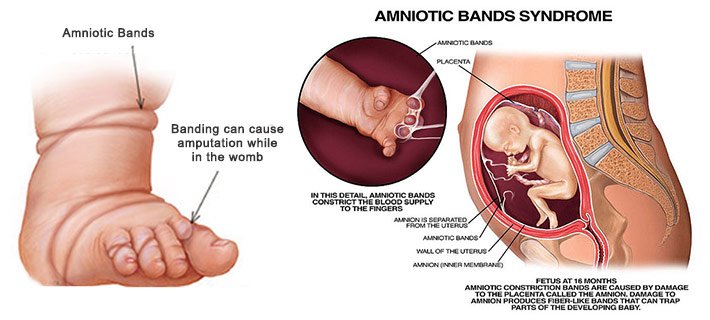 What Is Amniotic Band Syndrome? Healthinfi