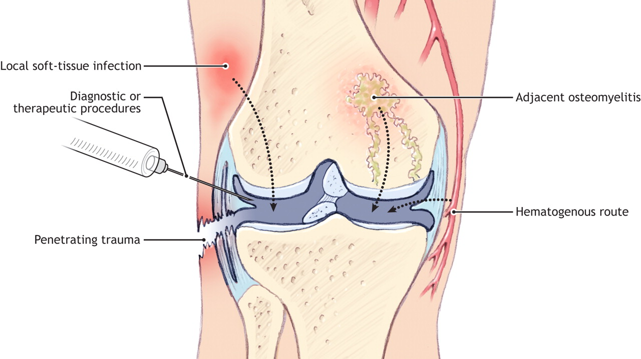 What Is Septic Arthritis? Symptoms, Diagnosis and Treatment