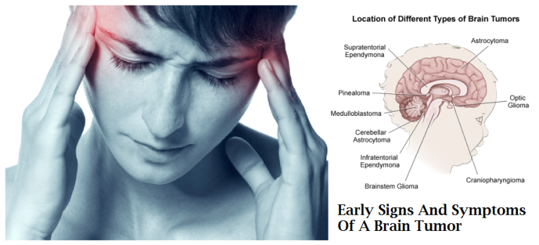 What Is a Brain Tumor?