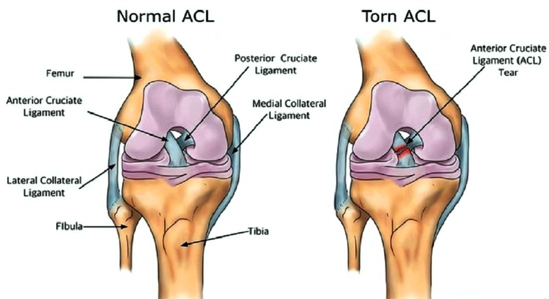 Anterior Cruciate Ligament (ACL) Anterior Cruciate Ligament (ACL)