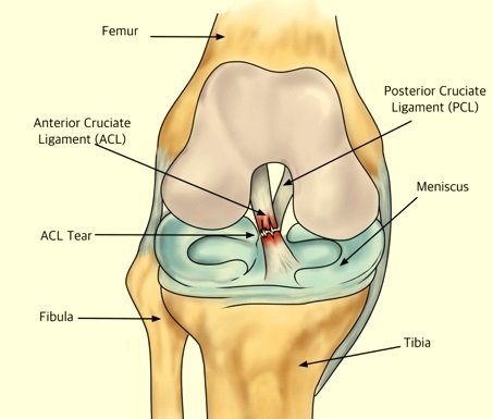 Anterior Cruciate Ligament (ACL) Anterior Cruciate Ligament (ACL)