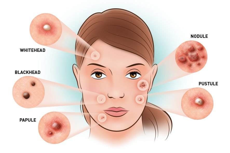 What Are Acne And Pimples? How Are They Different? What Are Acne And Pimples? How Are They Different?