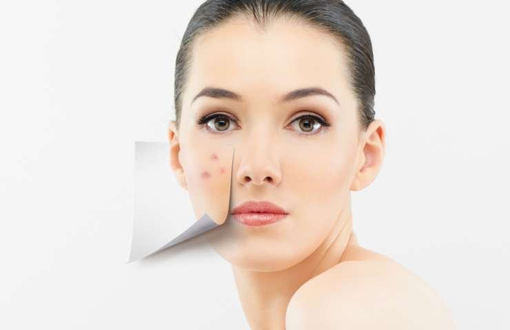 What Are Acne And Pimples? How Are They Different?