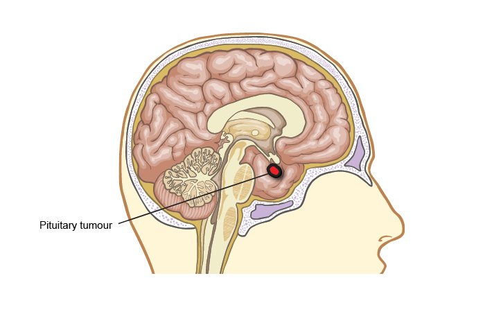 What Is Acromegaly? What Is Acromegaly?