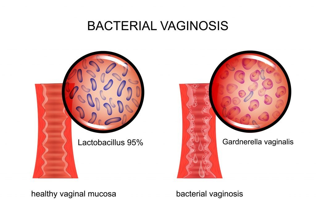 What Is Bacterial vaginosis? Causes, symptoms, and treatments
