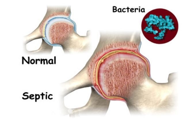 What Is Septic Arthritis? Symptoms, Diagnosis and Treatment