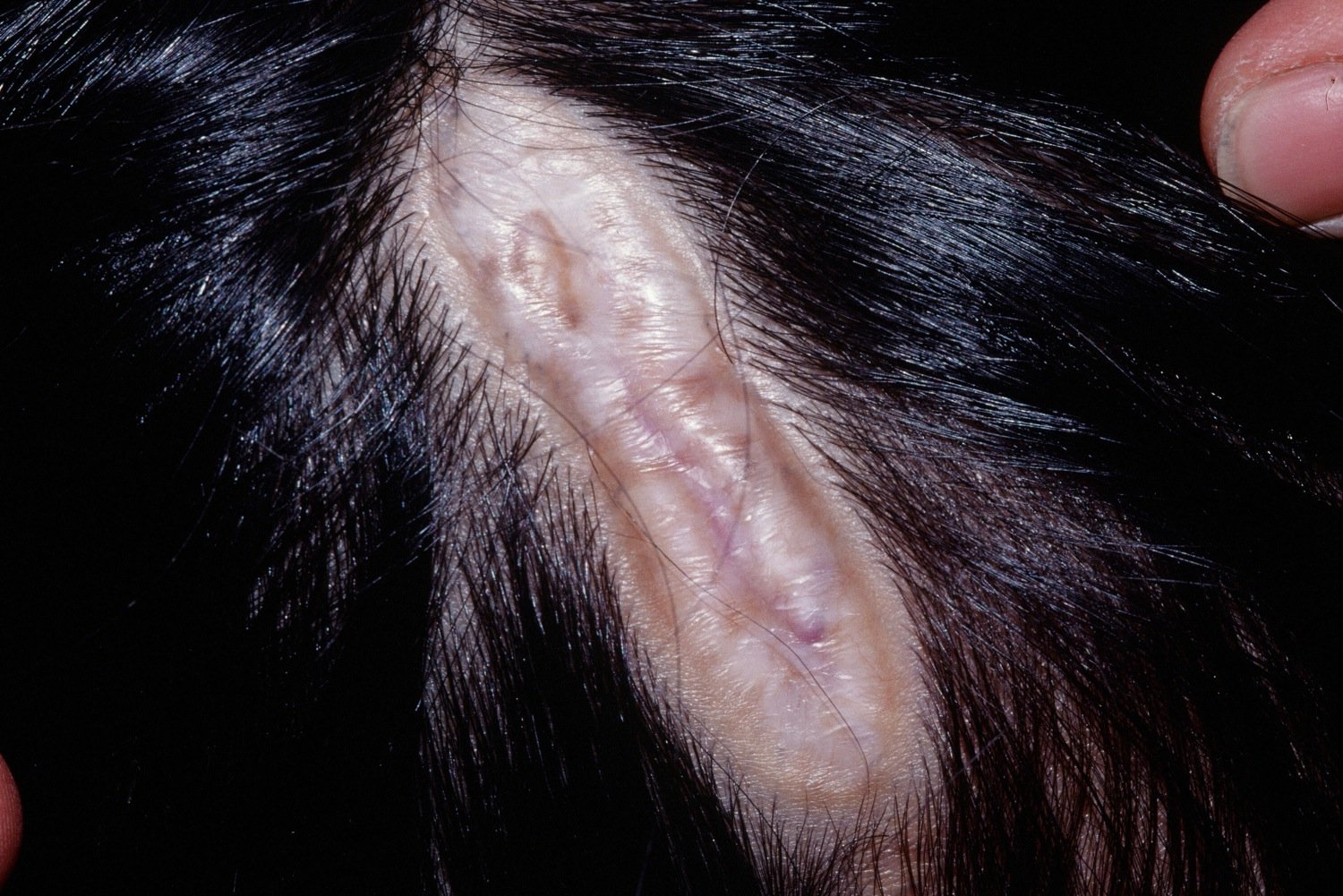 What Is ACC? (Aplasia Cutis Congenita)