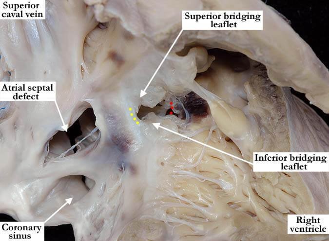 What Is Atrioventricular Septal Defect (AVSD)? What Is Atrioventricular Septal Defect (AVSD)?