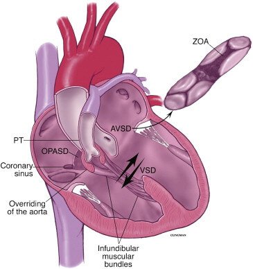 What Is Atrioventricular Septal Defect (AVSD)? What Is Atrioventricular Septal Defect (AVSD)?
