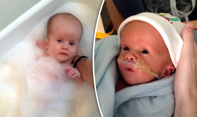 What Is Alobar Holoprosencephaly? What Is Alobar Holoprosencephaly?
