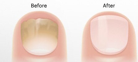 Yellow Nail Syndrome, Causes, And Treatment Yellow Nail Syndrome, Causes, And Treatment