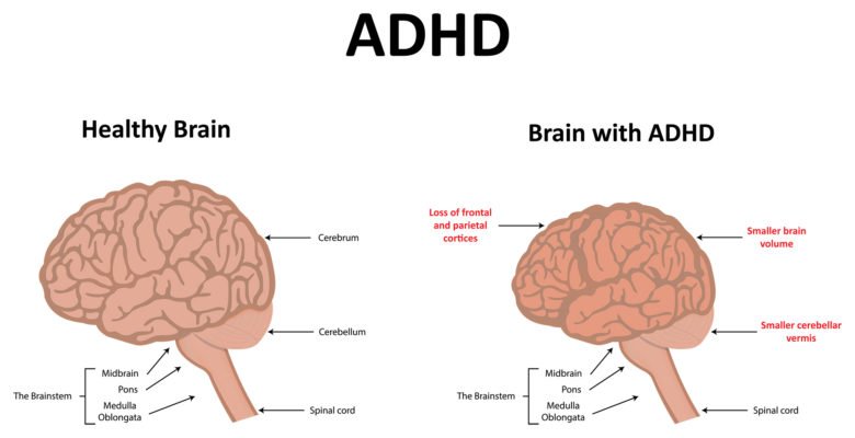 About ADD/ADHD About ADD/ADHD