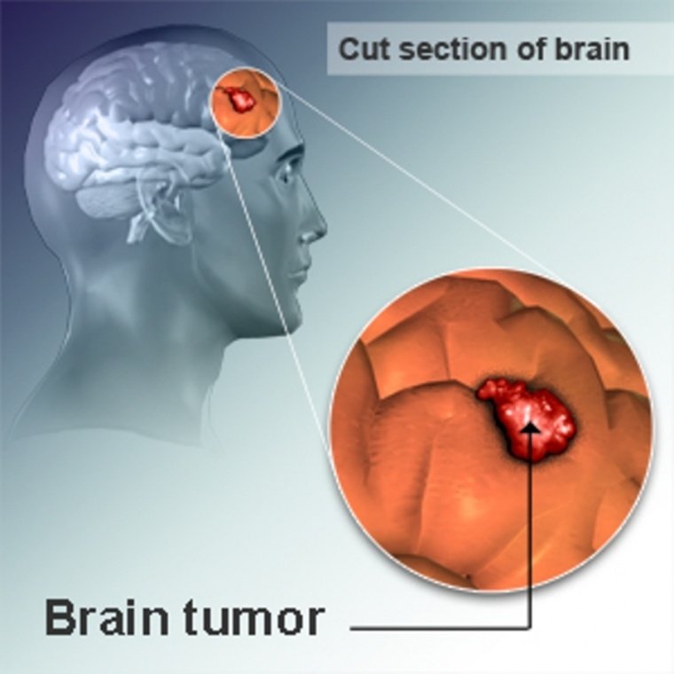 What Is a Brain Tumor?