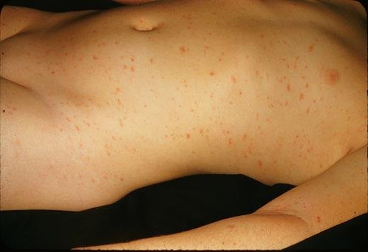 Meningococcal Meningitis: symptoms, Causes And Treatments.