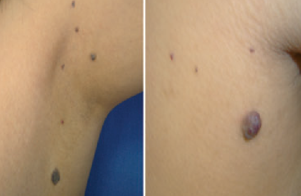 What Is Bean Syndrome? What Is Bean Syndrome?