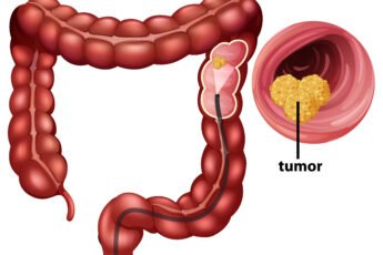 symptoms of colorectal cancer