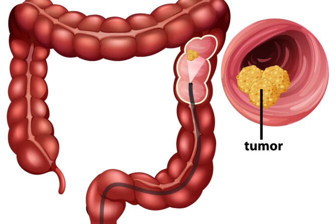 symptoms of colorectal cancer