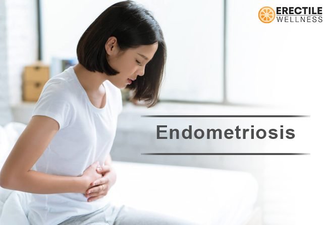 Endometriosis