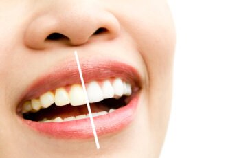 how to whiten teeth instantly