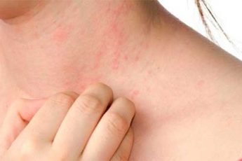 What Is Eczema? and Types of Eczema