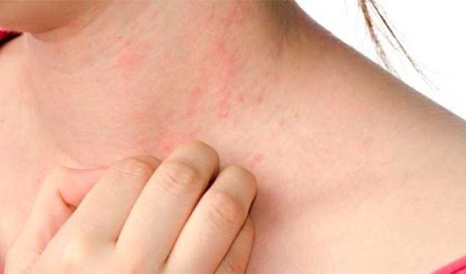 What Is Eczema? and Types of Eczema
