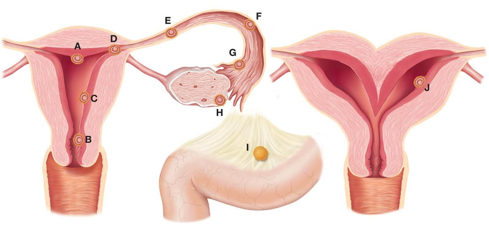 about ectopic pregnancy