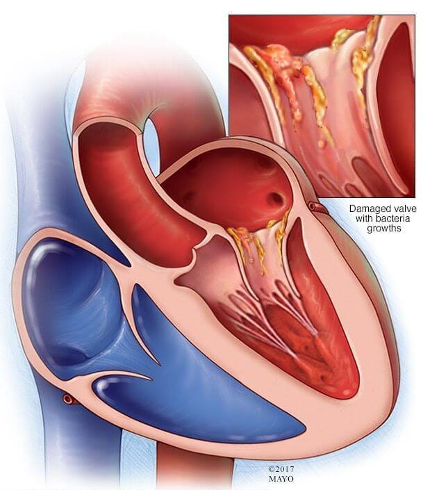 Endocarditis