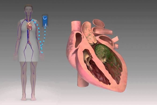 Endocarditis