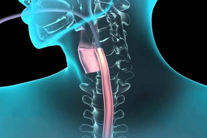 What Is Endoscopy and Types of Endoscopy