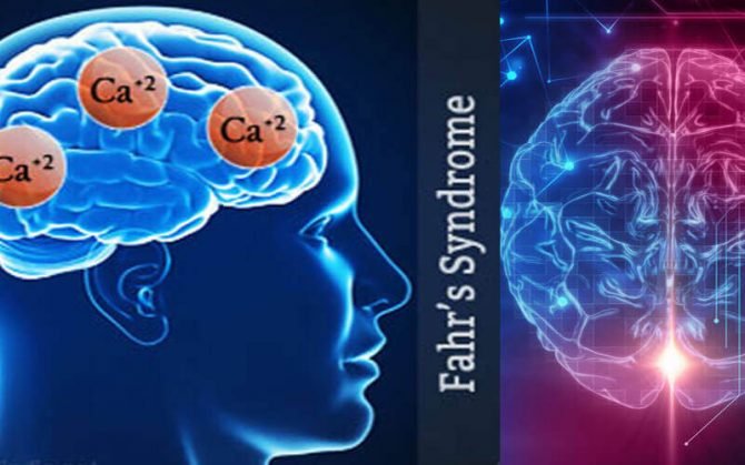 fahrs-syndrome-healthinfi