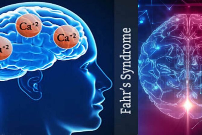 fahrs-syndrome-healthinfi