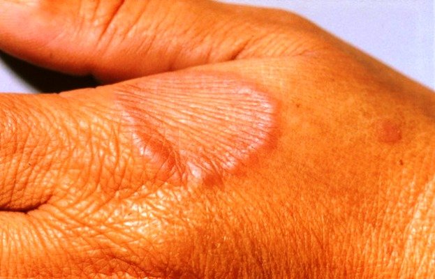 granuloma annulare-pictures-healthinfi