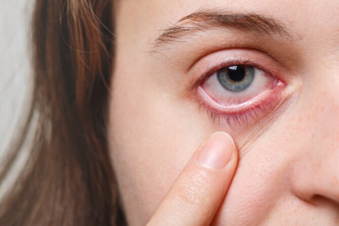 Pink eye