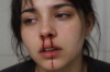 bloody nose