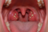 stones on tonsils