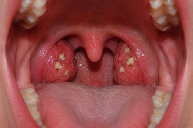 stones on tonsils