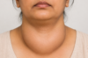 What is the fastest way to cure goiter