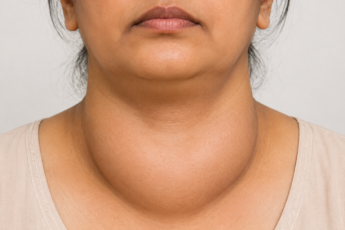What is the fastest way to cure goiter