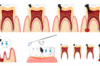 dental caries stages