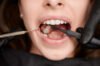 how to prevent dental caries